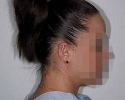 After Image: Patient # 88335 - right-side