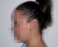 After Image: Patient # 88335 - left-side