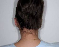 After Image: Patient # 88335 - back