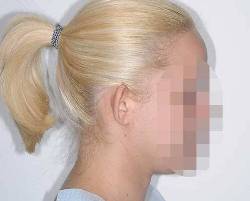Before Image: Patient # 88335 - right-side