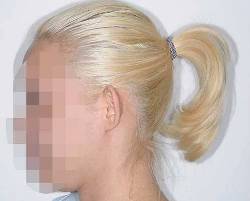 Before Image: Patient # 88335 - left-side