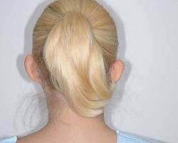 Before Image: Patient # 88335 - back