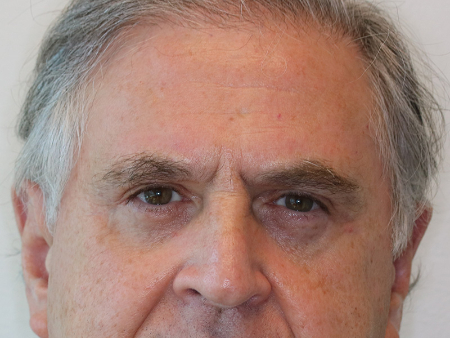 After Image: Patient # 72325 - front