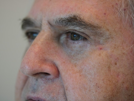 After Image: Patient # 72325 - left-front-oblique