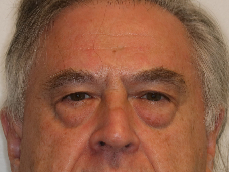 Before Image: Patient # 72325 - front