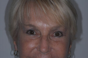 After Image: Patient # 74987