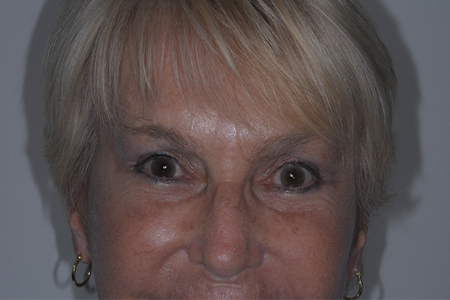 After Image: Patient # 74987 - front
