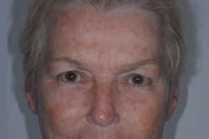 Before Image: Patient # 74987