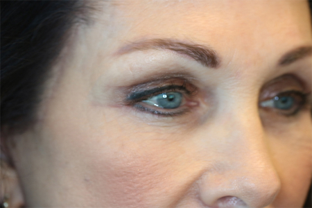 After Image: Patient # 89332 - right-front-oblique