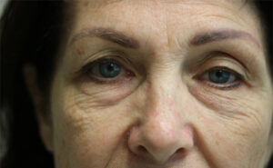 Before Image: Patient # 89332