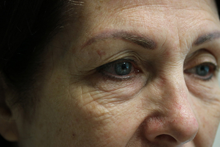 Before Image: Patient # 89332 - right-front-oblique