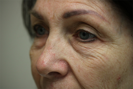 Before Image: Patient # 89332 - left-front-oblique
