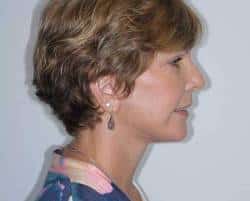 After Image: Patient # 13714 - right-side