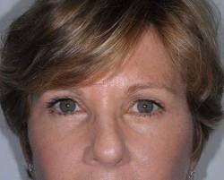 After Image: Patient # 13714 - front