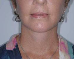 After Image: Patient # 13714 - front