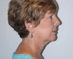 Before Image: Patient # 13714 - right-side