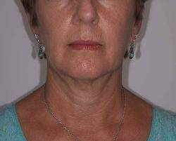 Before Image: Patient # 13714 - front