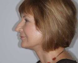 After Image: Patient # 13968 - left-side