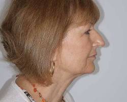 Before Image: Patient # 13968 - right-side