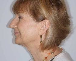 Before Image: Patient # 13968 - left-side