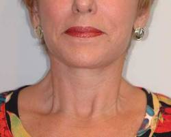 After Image: Patient # 17892 - front
