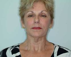 Before Image: Patient # 17892 - front