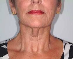 Before Image: Patient # 17892 - front