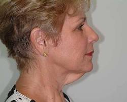 Before Image: Patient # 17892 - right-side