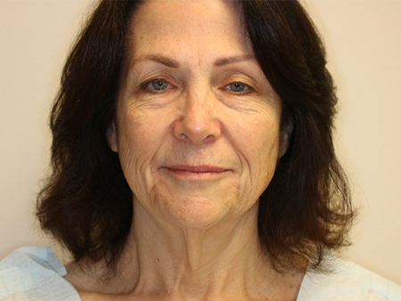Before Image: Patient # 32044 - front