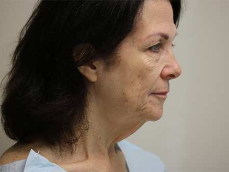 Before Image: Patient # 32044 - right-side