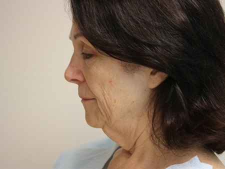 Before Image: Patient # 32044 - left-side