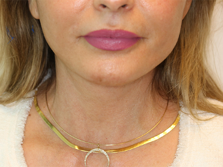 After Image: Patient # 43976 - front