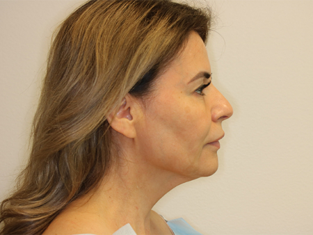 Before Image: Patient # 43976 - right-side
