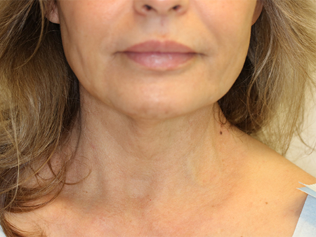 Before Image: Patient # 43976 - front