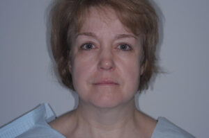 Before Image: Patient # 59150