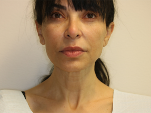 After Image: Patient # 67875
