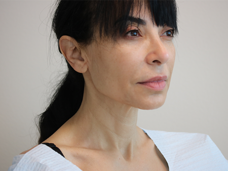 After Image: Patient # 67875 - right-front-oblique