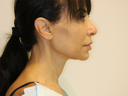 After Image: Patient # 67875 - right-side