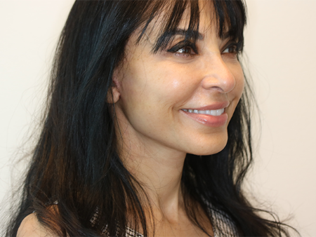 Before Image: Patient # 67875 - right-front-oblique