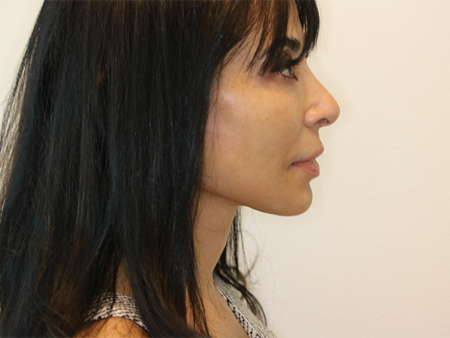 Before Image: Patient # 67875 - right-side