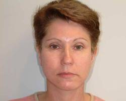 After Image: Patient # 69985 - front