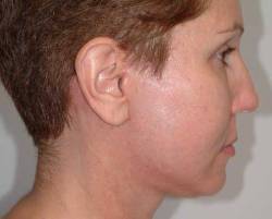 After Image: Patient # 69985 - right-side