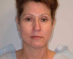 Before Image: Patient # 69985 - front