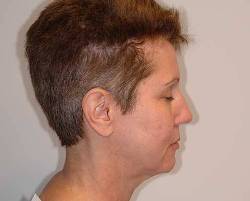 Before Image: Patient # 69985 - right-side