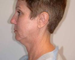 Before Image: Patient # 69985 - left-side