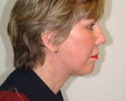 After Image: Patient # 73956 - right-side