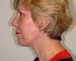 After Image: Patient # 73956 - left-side