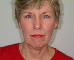 Before Image: Patient # 73956 - front