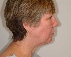 Before Image: Patient # 73956 - right-side