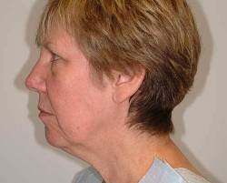 Before Image: Patient # 73956 - left-side